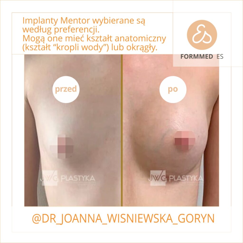 powiększenie piersi - implanty - dr joanna wiśniewska Goryń Formmed - 9